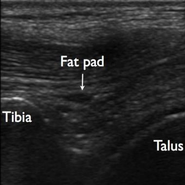 Ultrasound image of normal ankle anatomy. The tibi