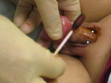 Anesthetic injection sites in the 10- and 2-o'cloc