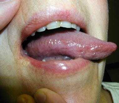 Klonopin burning mouth syndrome