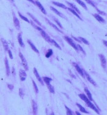 Mitotic figure in a myxoid smooth muscle tumor. On