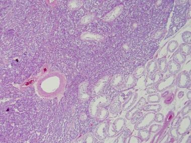 Spermatocytic Tumor Pathology. In this case, the t