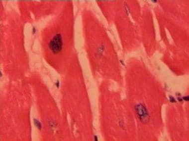 Histologic section of an autopsy myocardial specim