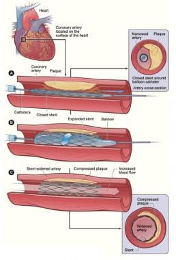 Comparison of Coronary Artery Bypass Grafting (CAB