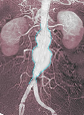 Angiogram showing fusiform aortic aneurysm. 