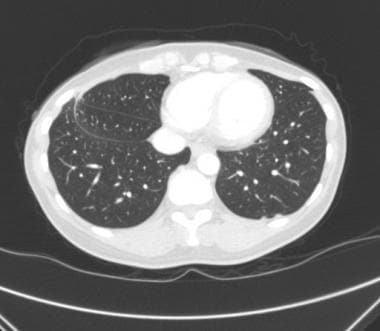 CT scan of chest in patient with congenital third 