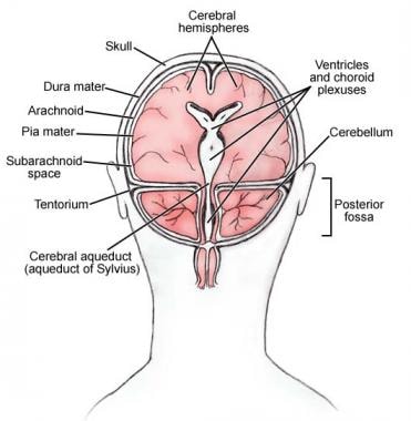 Pathophysiology Of Hydrocephalus In Flow Chart