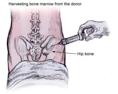 Bone marrow stem cells are aspirated from the post