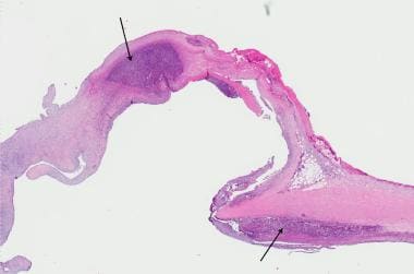 bacterial endocarditis histology