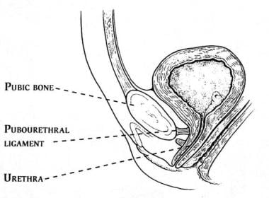 The pubourethral ligaments suspend the female uret