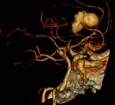 CT angiography reconstruction shows large, irregul