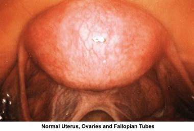 Infertility. Normal uterus, ovaries, and fallopian