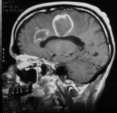 Sagittal T1-weighted contrast-enhanced MRI reveals
