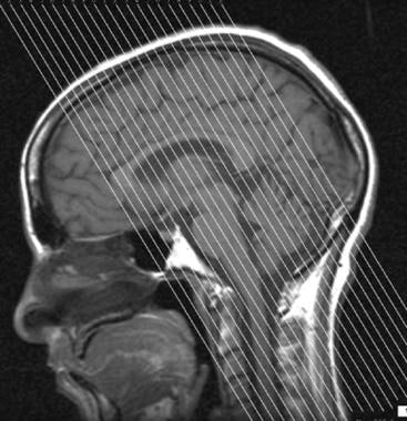Midline magnetic resonance image with proper secti