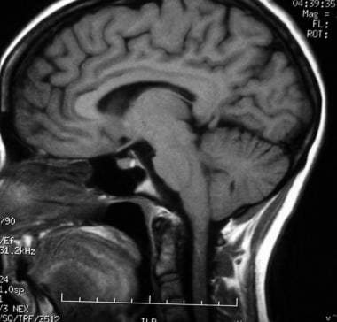 T1-weighted sagittal MRI through the pituitary fos