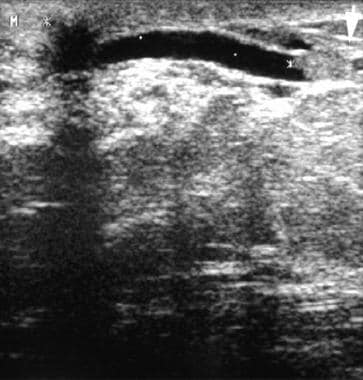 A 45-year-old woman with serosanguineous discharge