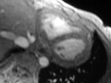 Restrictive cardiomyopathy. Axial double inversion