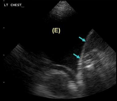 Ultrasonogram of the left lower chest in a 47-year