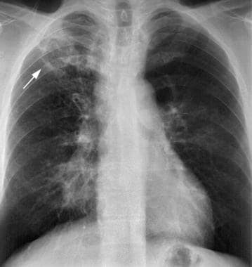 Chest X Ray Tb