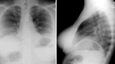 Posteroanterior and lateral chest radiographs reve