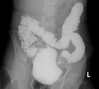 Single-contrast barium enema study demonstrates si