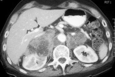 Contrast-enhanced CT scan depicts heterogeneously 