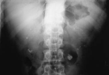 Radiograph depicting bilateral nephrocalcinosis in