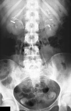 An intravenous urogram in a 36-year old woman who 
