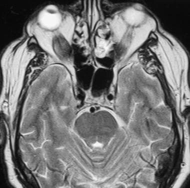 MRI axial section demonstrates enlarged inferior r