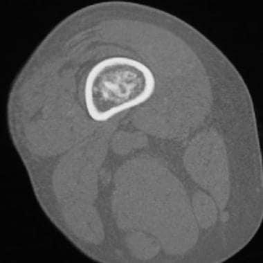 Enchondroma. Axial computed tomography image demon