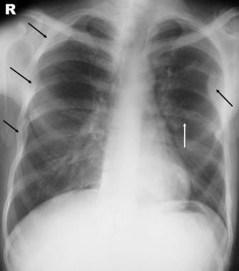 Posteroanterior (PA) chest radiograph shows multip
