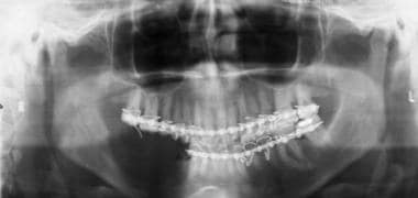 Panoramic radiographic image of the lesion through