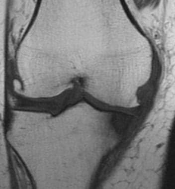 T1-weighted coronal MRI of the knee shows typical 