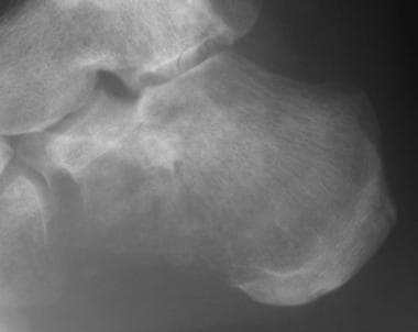 Lateral radiograph of the calcaneum in an adult wi