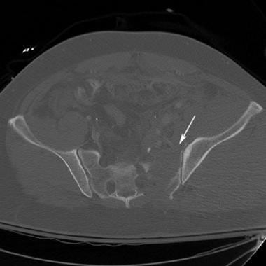 Open book pelvic injury, Radiology Reference Article