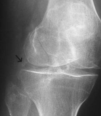 Oblique radiograph of the right knee demonstrates 