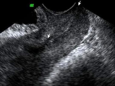 Transvaginal sonogram in early pregnancy showing a
