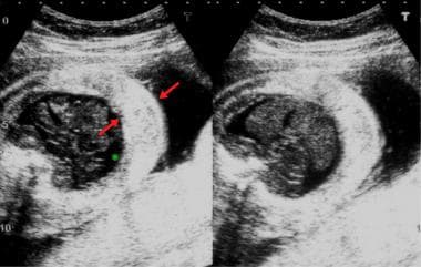 hydrops ultrasound