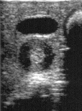 Transverse ultrasonographic image in a patient wit