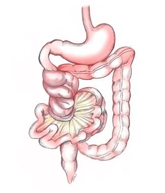 Malrotation with midgut volvulus shows torsion aro