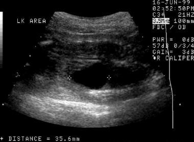 A first prenatal sonogram. This image demonstrates