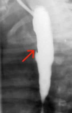 H-type tracheoesophageal fistula (TEF). Oblique ba