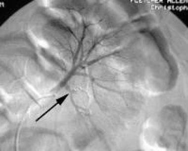 Postembolization left renal angiogram (same patien