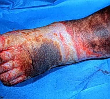 Third-degree burns are usually leathery, dry, inse
