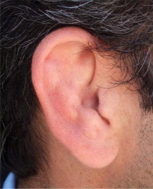 Cauliflower ear. 