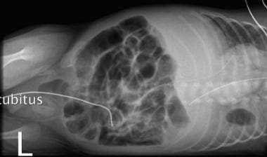 Lateral chest radiograph of a newborn with a left 