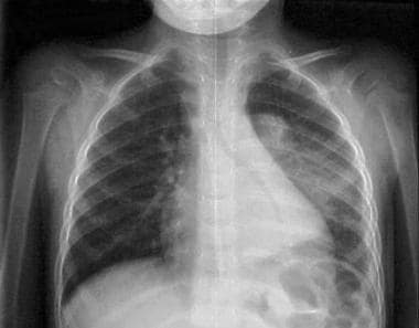 Upright chest radiograph in a 3-year-old child wit
