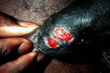 Close-up view of chancroid ulcers. 