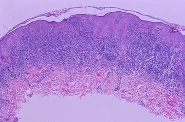 congenital melanocytic nevus histology