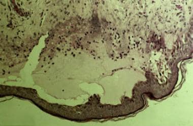 Papillary microabscesses form and progress to sube