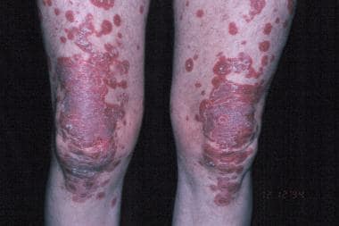 Papulosquamous lesions of subacute cutaneous lupus